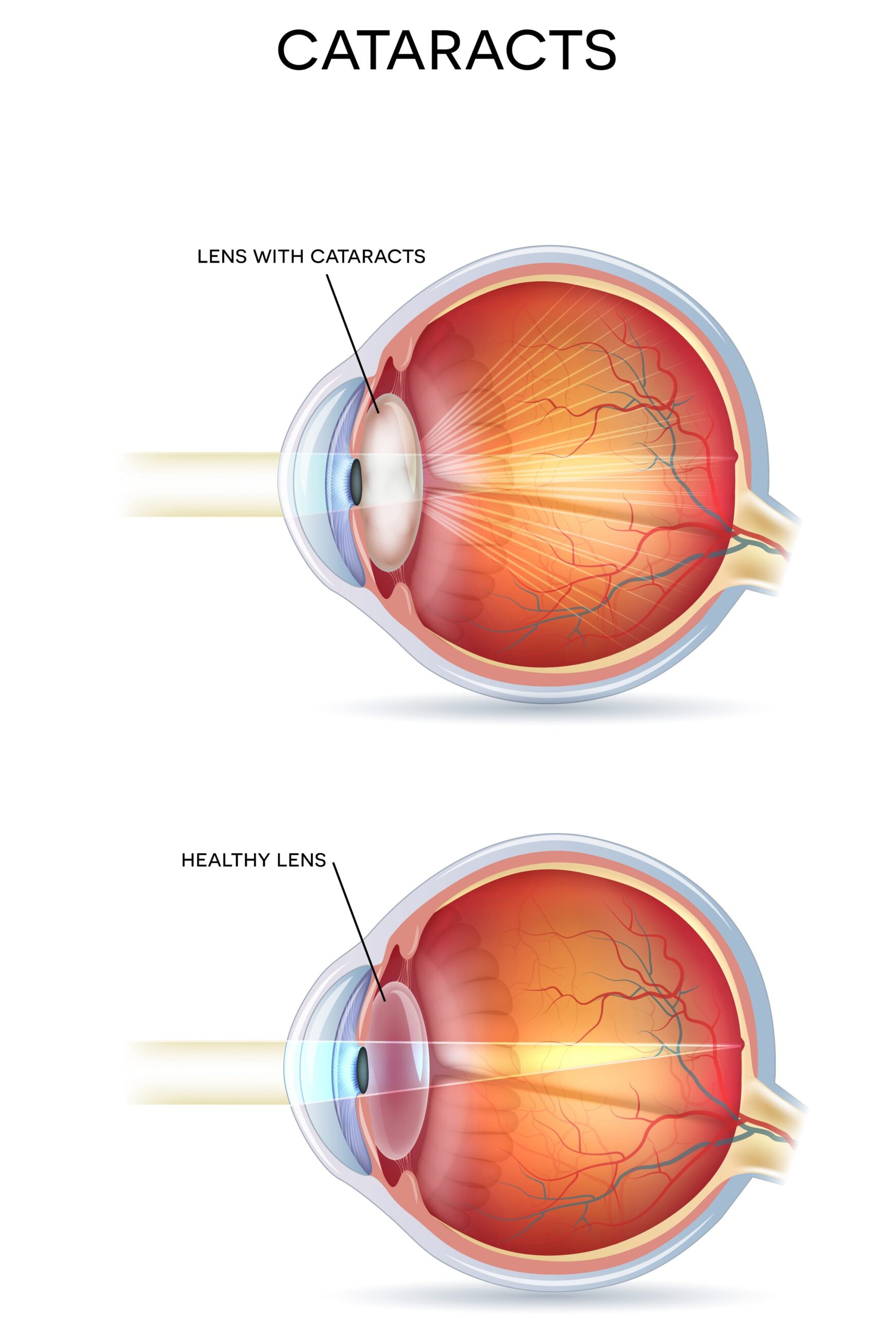 Cataract Alliance | Azure Eye | Fort Worth